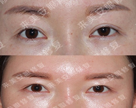 您好,恢复成单眼皮是不太可能的,但是可以尽量修复的窄一些形成墨双