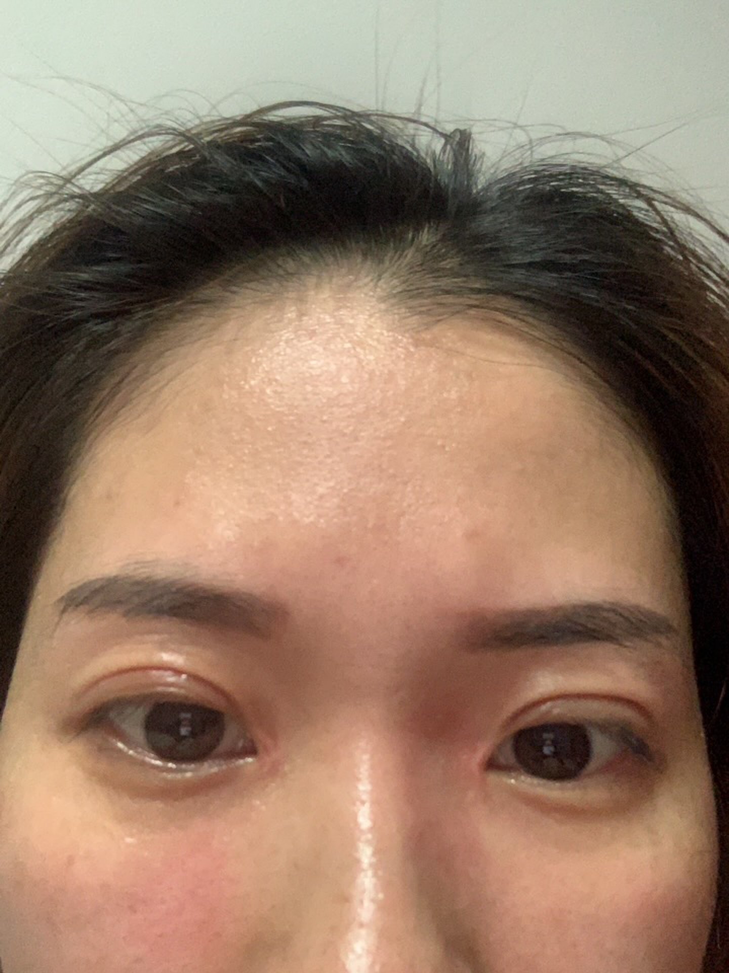 一月份割的双眼皮左眼严重凹陷出现三眼皮症状眼角疤至今未好请问疤能