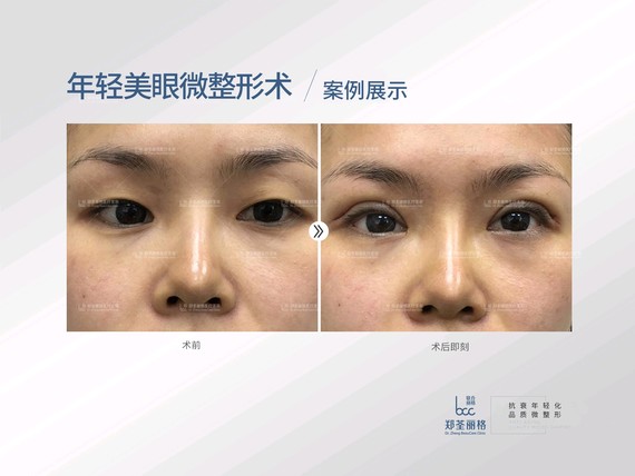 您好,我们都知道割双眼皮的方法一般有三种,每