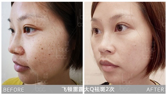 9797激光祛斑后护_圈子-新氧美容整形