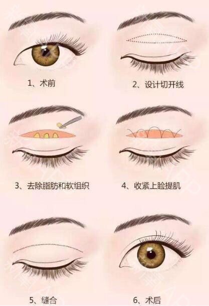 双眼皮出现肉条感的原因有很多.