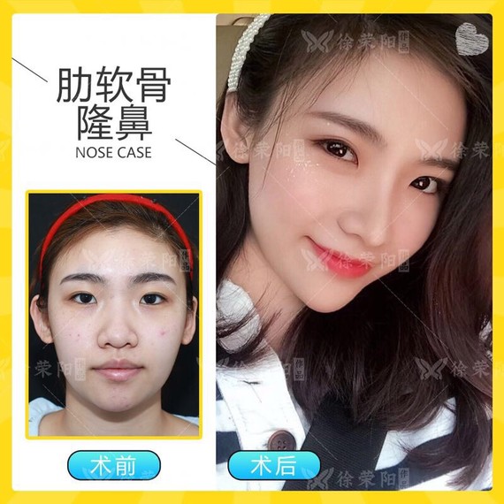 你好,假体有分为硅胶、膨体、超体1.硅胶材料