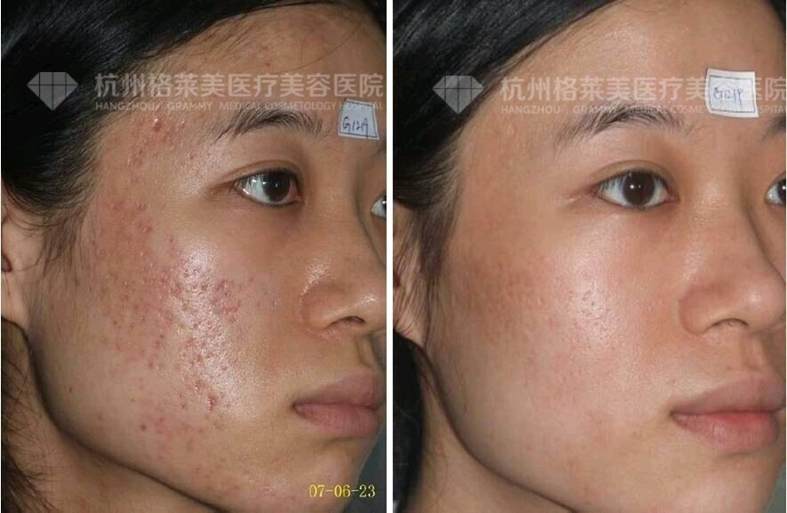 果酸换肤术属于"表浅化学换肤术"的一种.