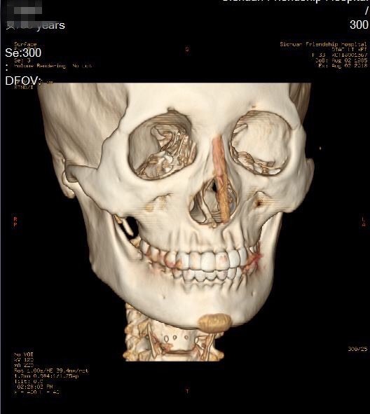 下颌角整形术前注意事项