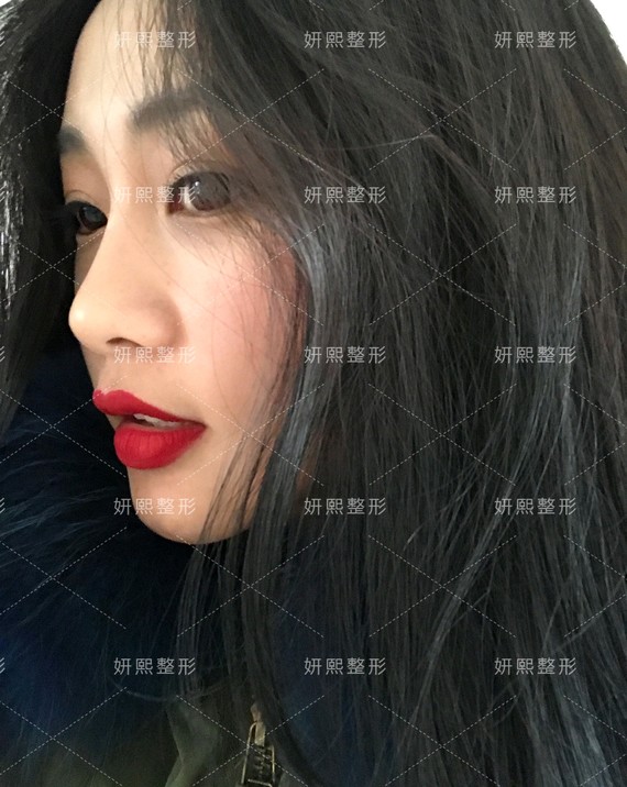 你好,手术都是有风险的,一定要去正规医院,找专