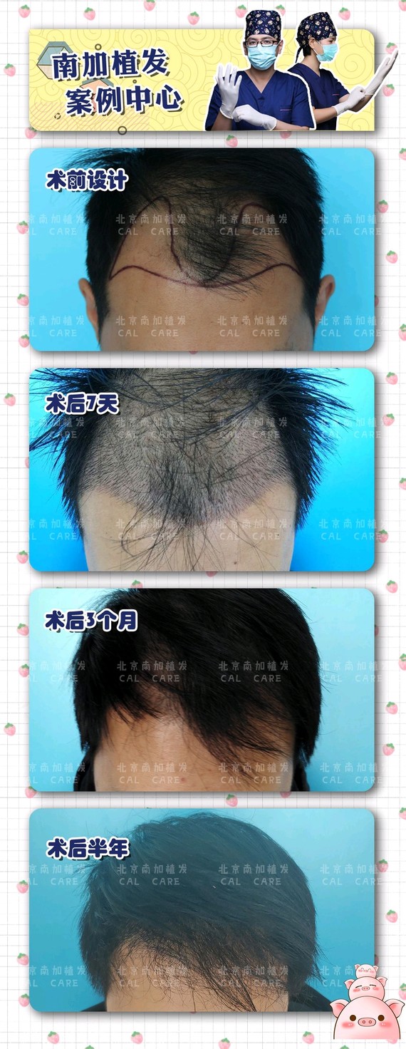 你好,做完植发手术后,移植后的毛发会逐渐脱落