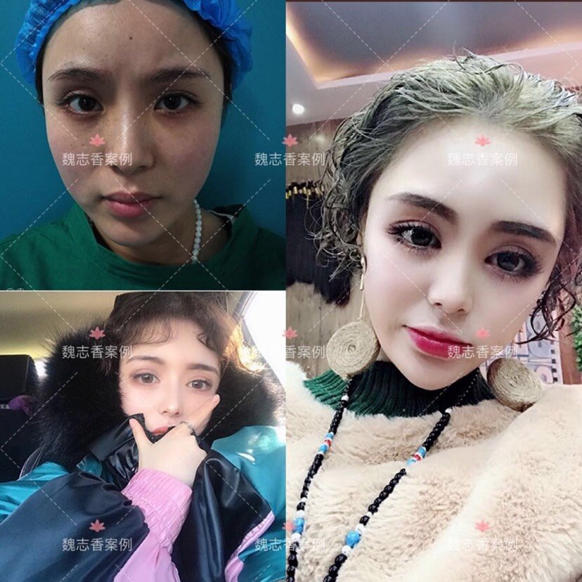 做完眉弓恢复期多久啊影响正常生活吗 新氧 专业医美服务平台 做完眉弓恢复期多久啊影响正常生活吗 新氧 专业医美服务平台