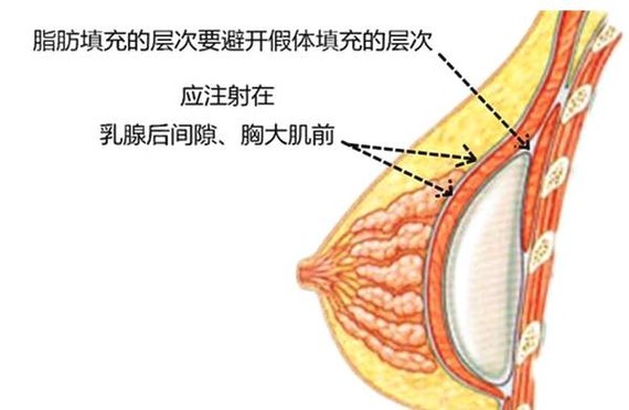 由于上述两种植入的方式其胸假体均不在我们的乳腺层,为什么我