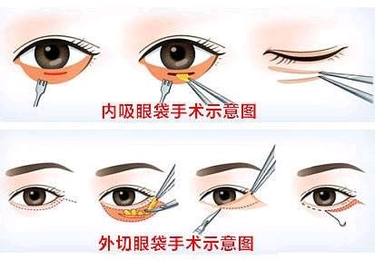 内路眼袋也叫做经结膜入路的下眼袋切除术,外