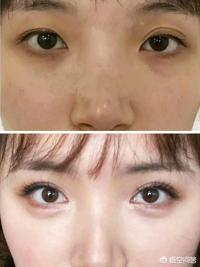 上眼睑下垂,做双眼皮手术,能保持多长时间?