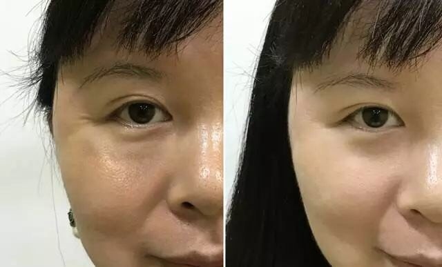 如何去除眼角的鱼尾纹,有什么好的办法去除鱼尾纹的方法真是太多了