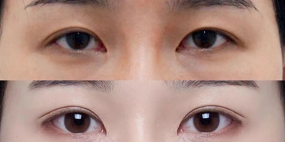 提上睑肌缩短术适应于双侧或单侧轻度或中度先天性上睑下垂,且提上睑