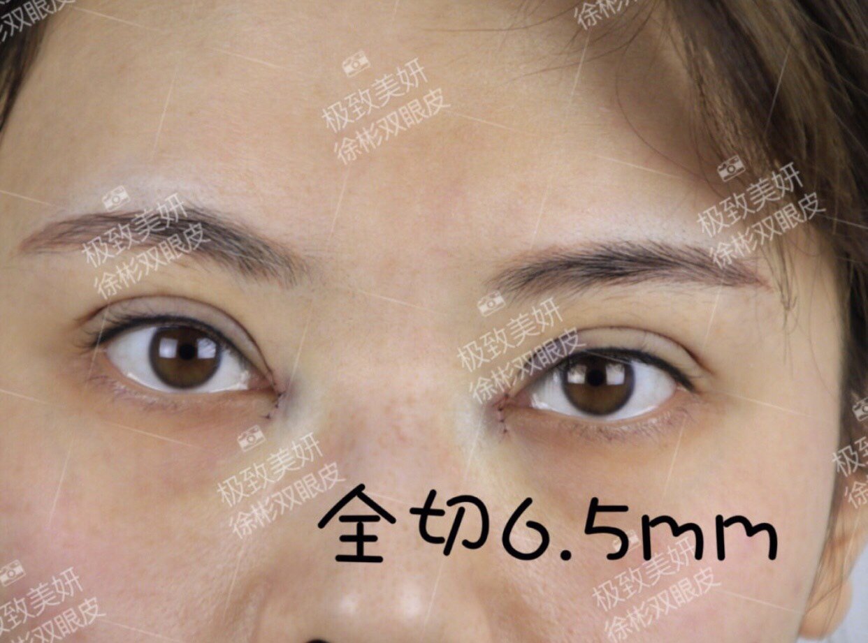 是睑板的宽度 (一般亚洲人的睑板宽度都不会超过10mm) 双眼皮的形成是