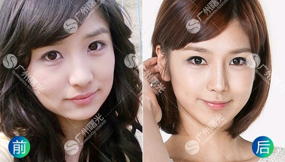 玻尿酸隆鼻是短暂的,只能维持一到两年的时间