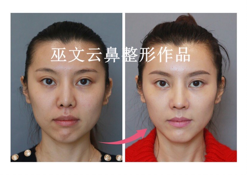 Prp Prf Svf是什么意思 哪个对脂肪填 新氧 专业医美服务平台