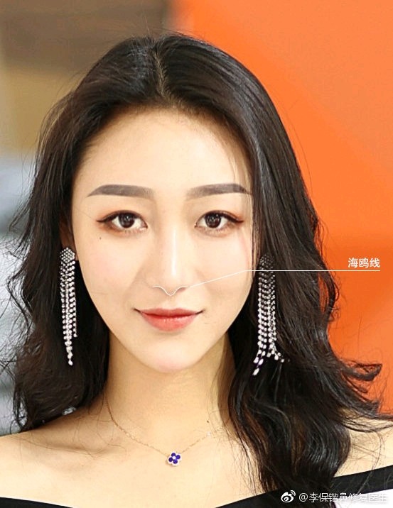 鼻部"海鸥线"就是指正面看鼻子时,鼻头和_圈子-新氧美容整形