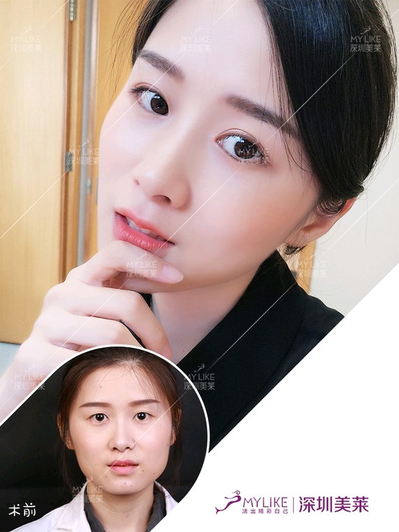 埋线双眼皮:是通过缝合方式,直接把缝线(或高分