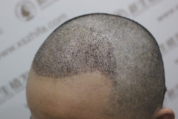 你好,这是可以的,头发种植并不是每个人都可以