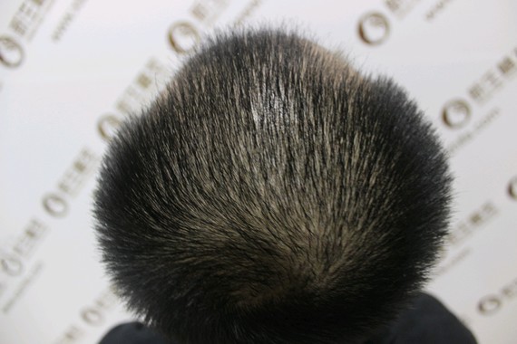 你好,这是可以的,头发种植并不是每个人都可以