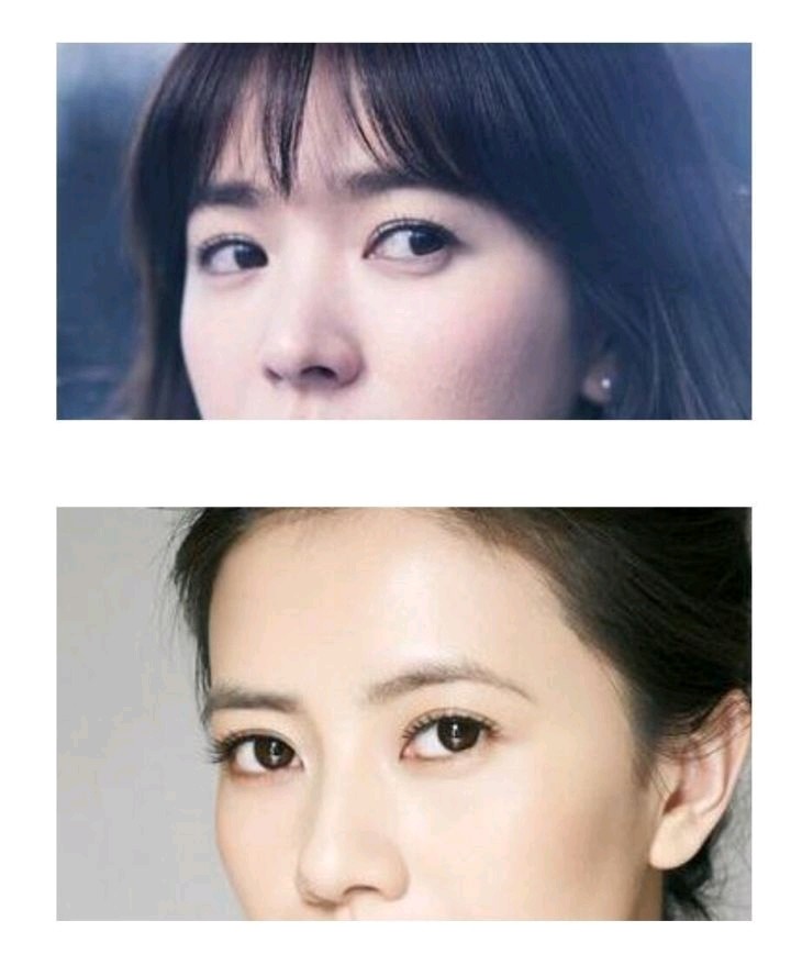 双眼皮形态有哪些?