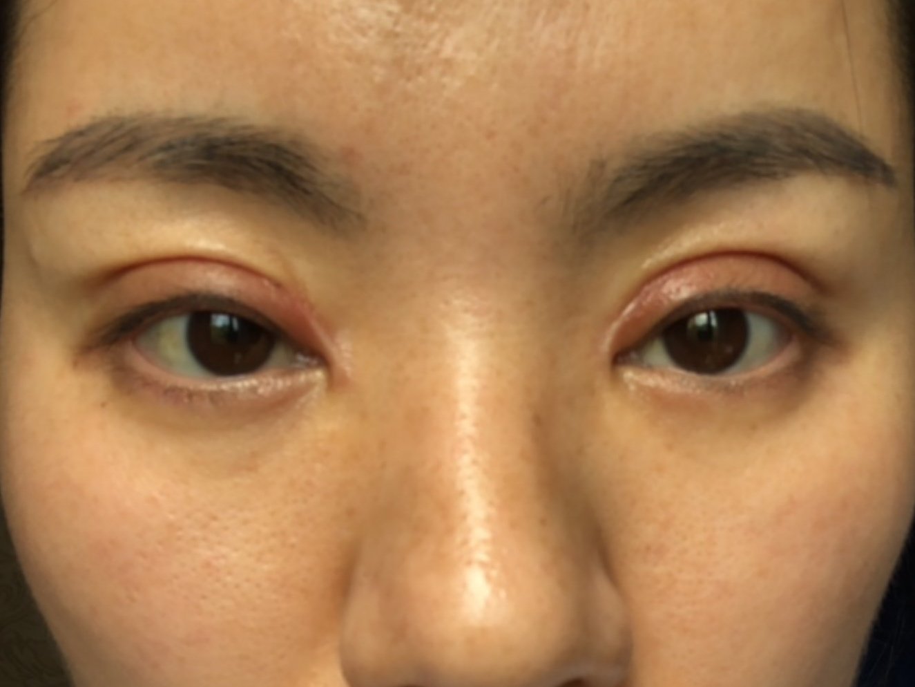 内眼角增生严重每天巴克在涂左眼上眼皮有褶皱线头还有外露怎么会这
