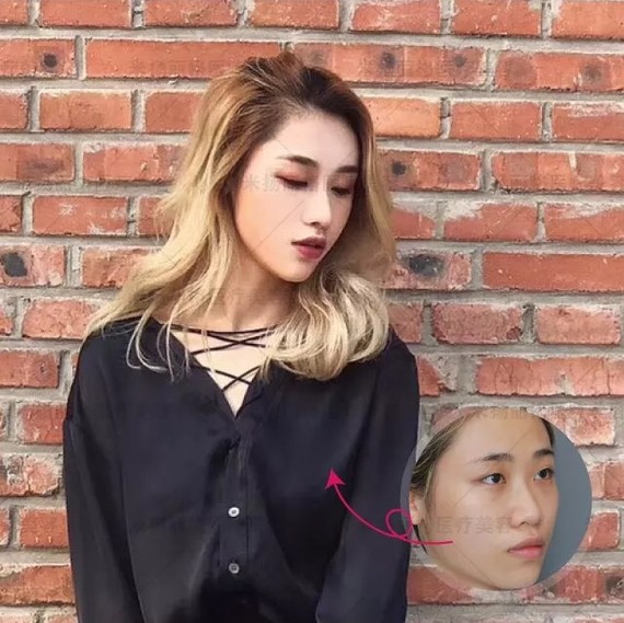 你好,隆鼻找正规医院专业的医生做,做好了,效果