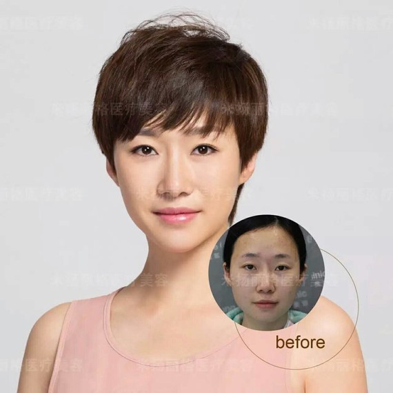 你好,隆鼻找正规医院专业的医生做,做好了,效果