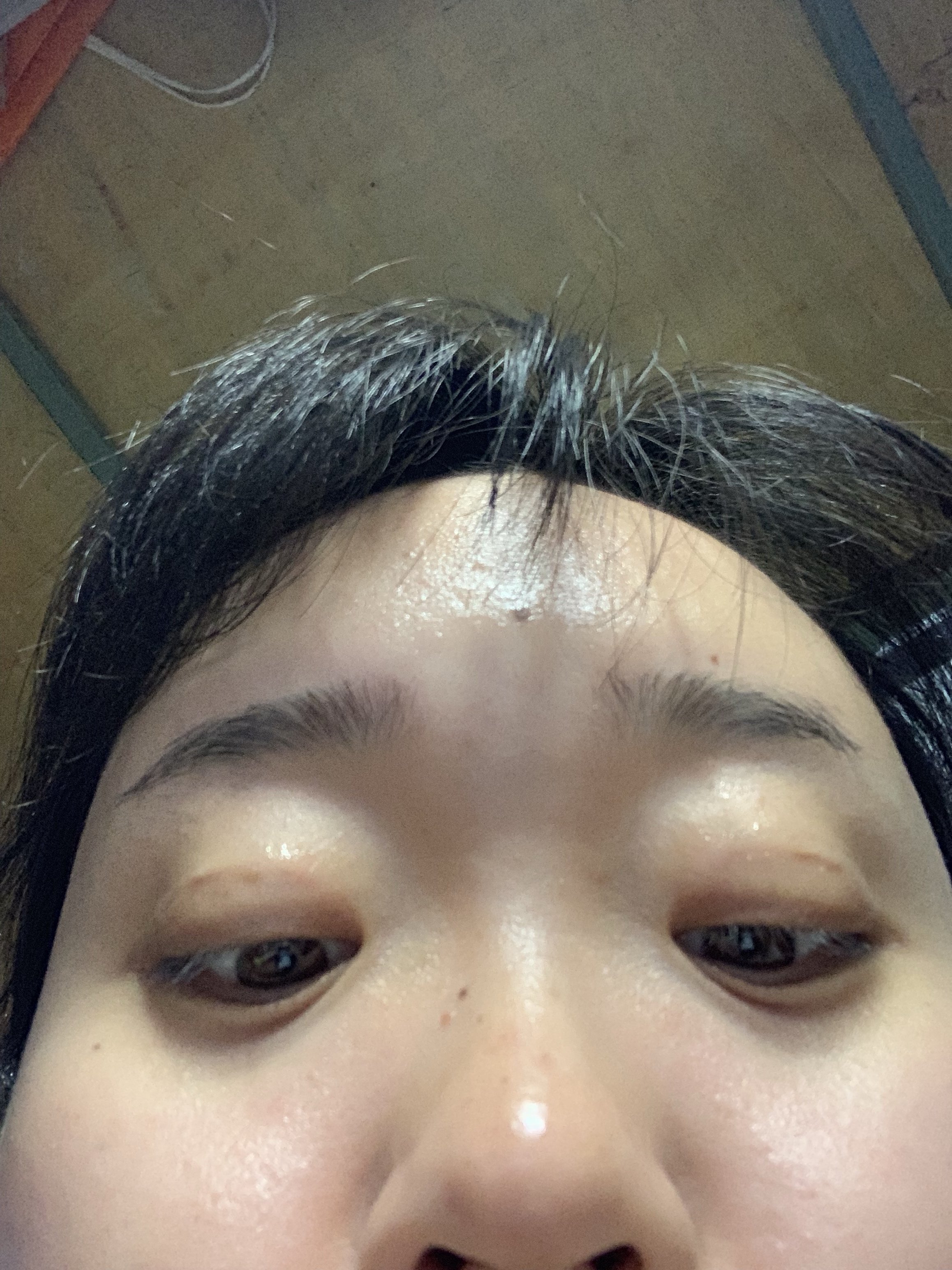 埋线双眼皮第十七天,右眼皮有一个没有颜色的硬疙瘩,不知道是不是增生