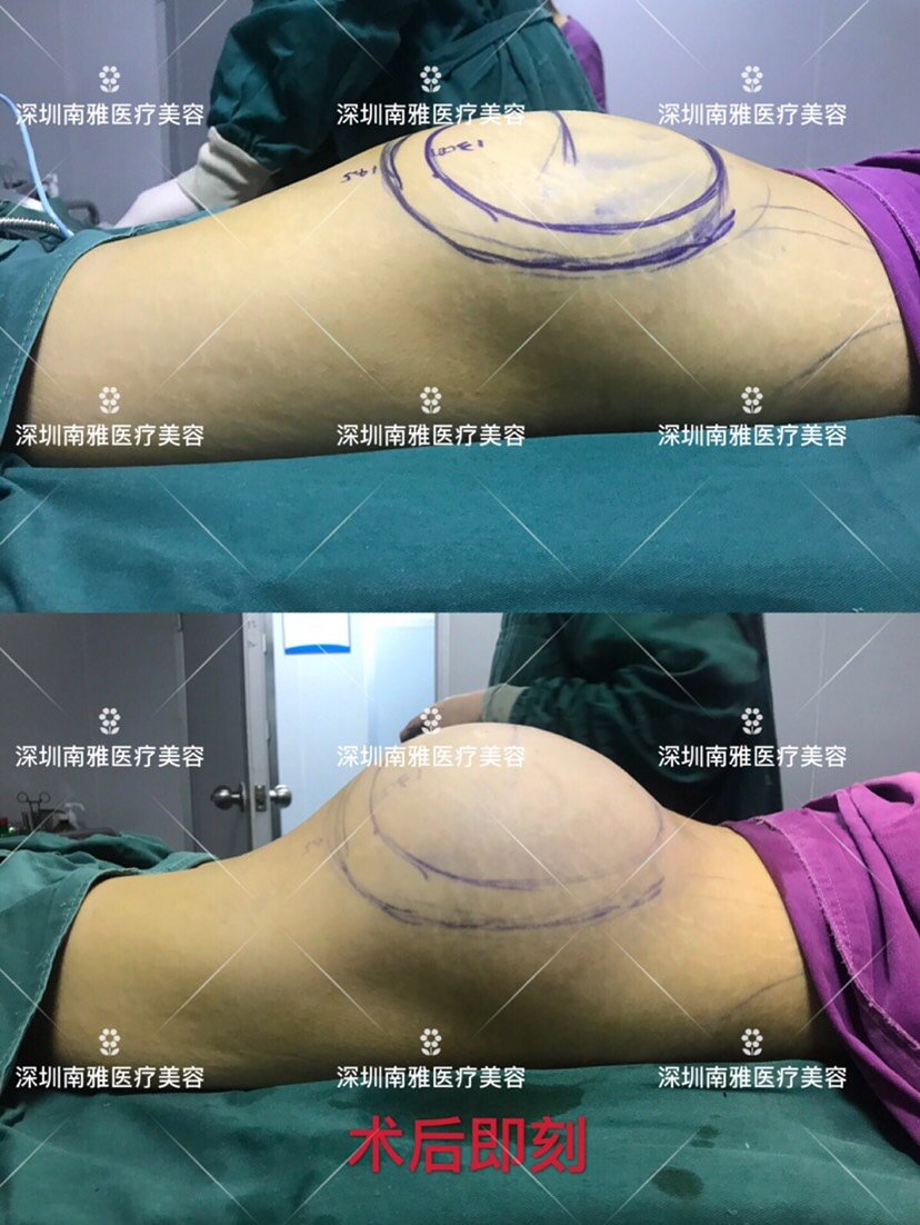臀部抽脂手术前后照片图片
