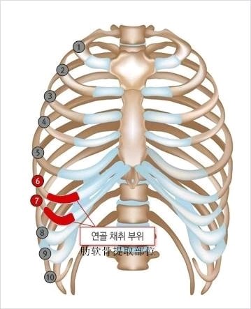 鼻部多项做半肋好还是全肋好 新氧美容整形