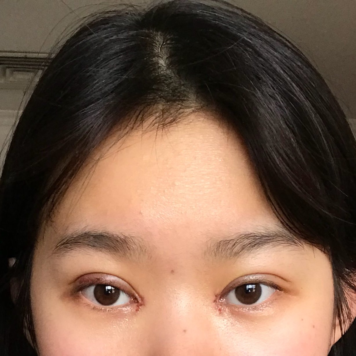 埋线双眼皮开眼角第三天请问我眼间距是不是过于近了这算失败吗