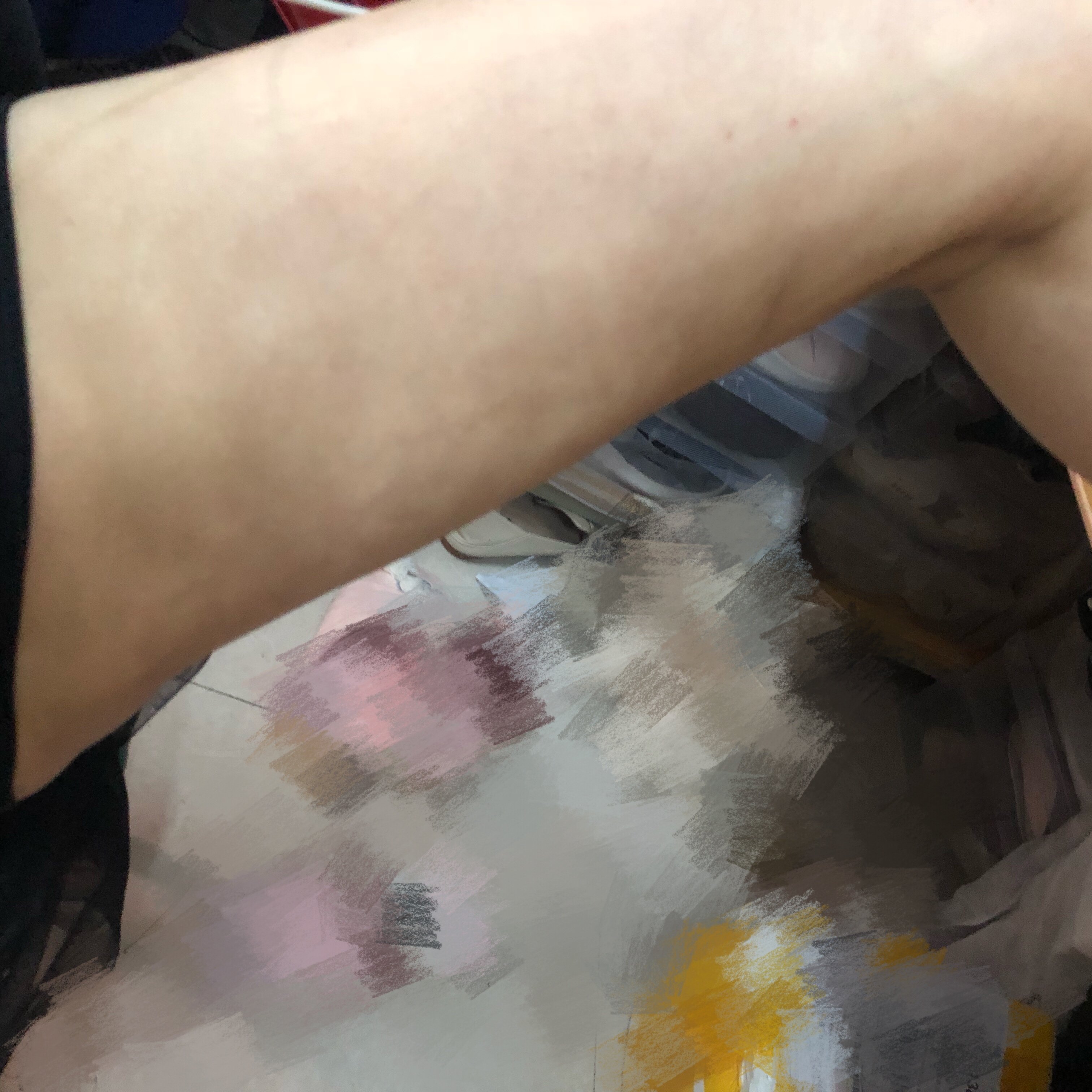 大腿吸脂1天了色素沉着腿部忽大忽 新氧美容整形