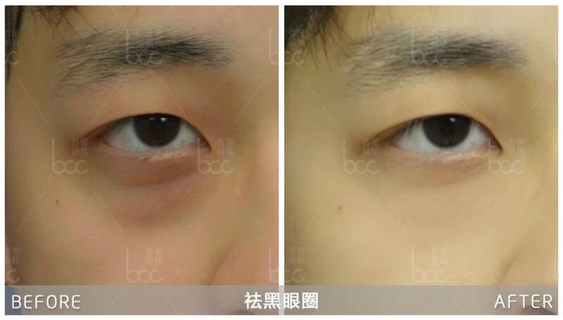 一晚睡就黑眼圈很重 新氧美容整形