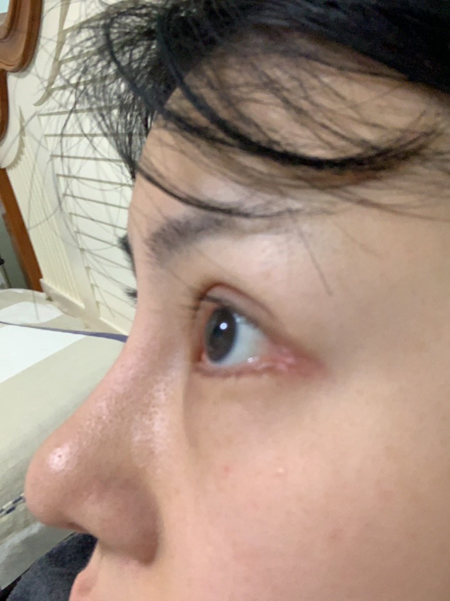 我做了眼睑下至开外眼角是不是做失败了现在两眼不对称一只眼睛是三角