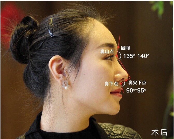 你好,如果对目前鼻子形态不满意,可以做修复改善,照片看鼻根鼻背和