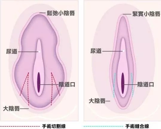 我这个阴唇肥大是小时候不懂事 自己用 新氧美容整形