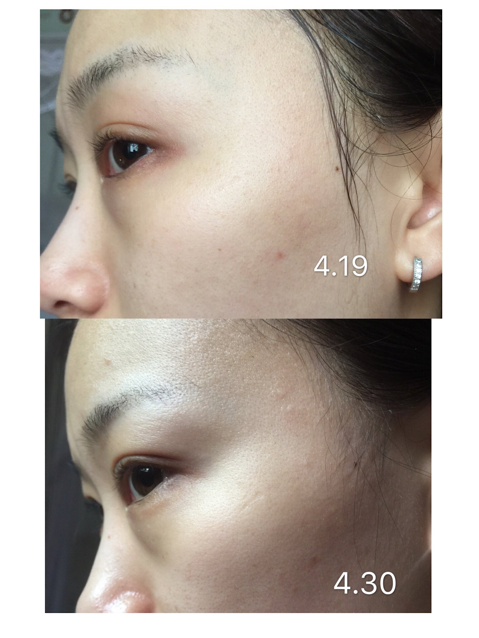 您好 我想咨询下关于去眼袋手术 我今 新氧美容整形