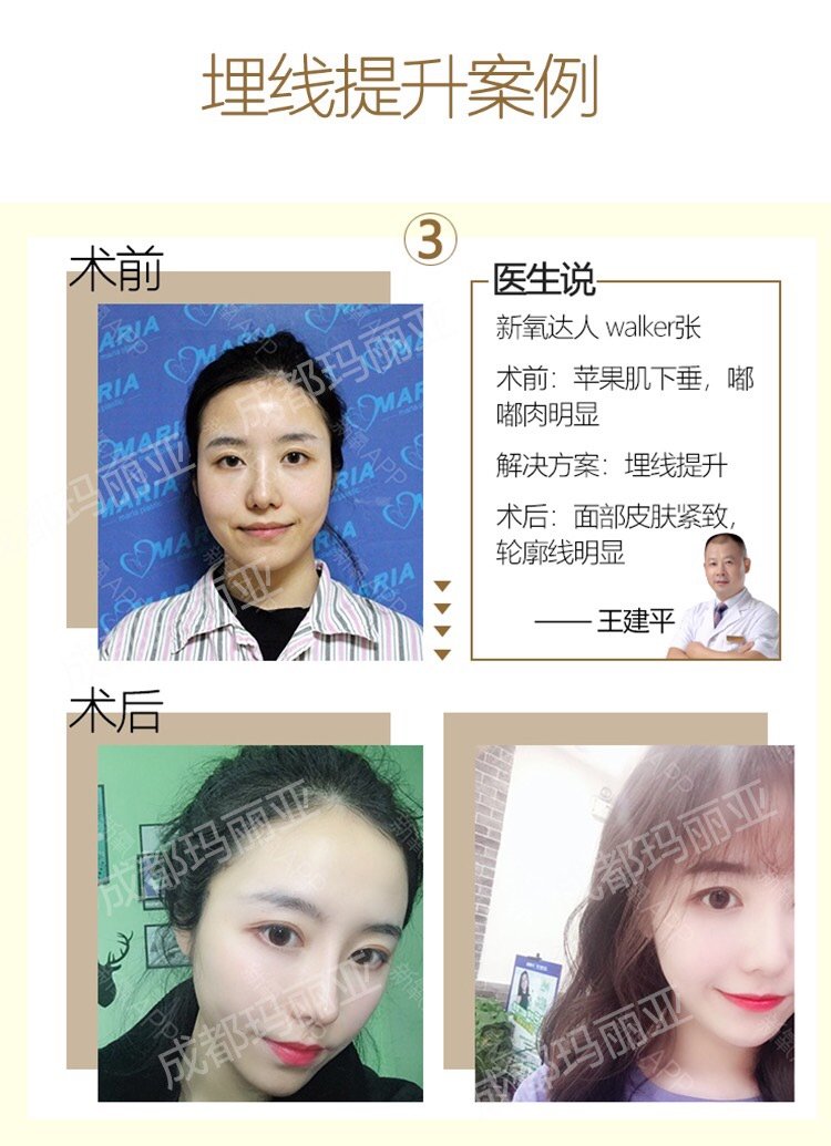 做了线雕感觉面部凹凸不平 多久才能消 新氧美容整形