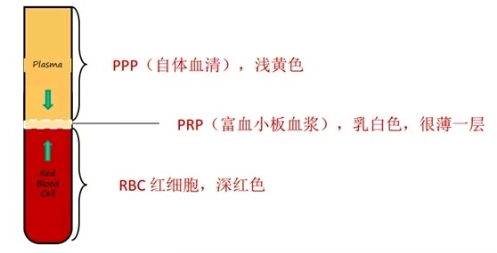 (圖1離心分層後的血液,乳白色prp是很薄一層,僅專業離心製備可製取)