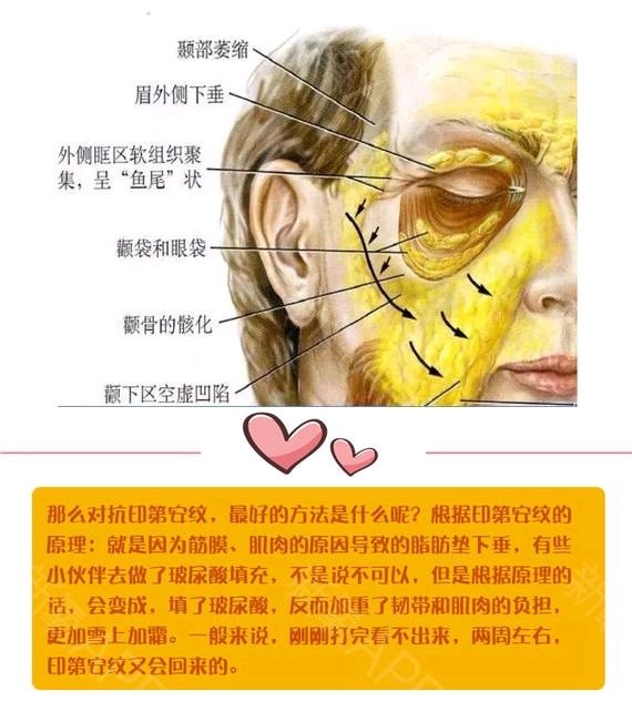 97如何去除印第安纹?