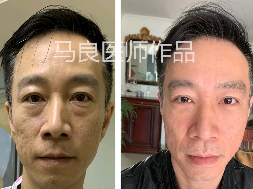 您好 我想咨询下关于去眼袋手术 我今 新氧美容整形