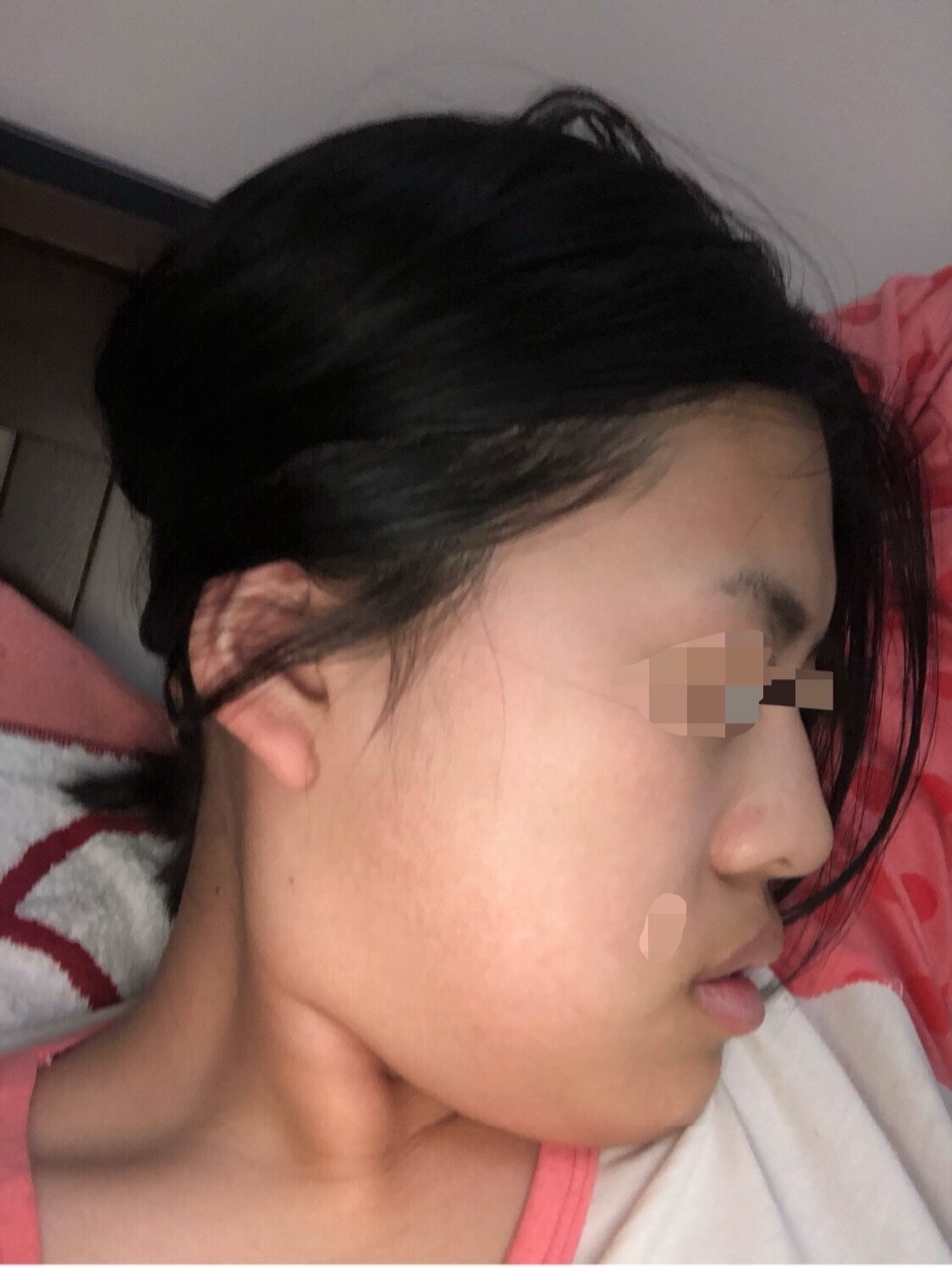 嘴突侧面丑没下巴正面笑起来很难看想矫正如最后一图
