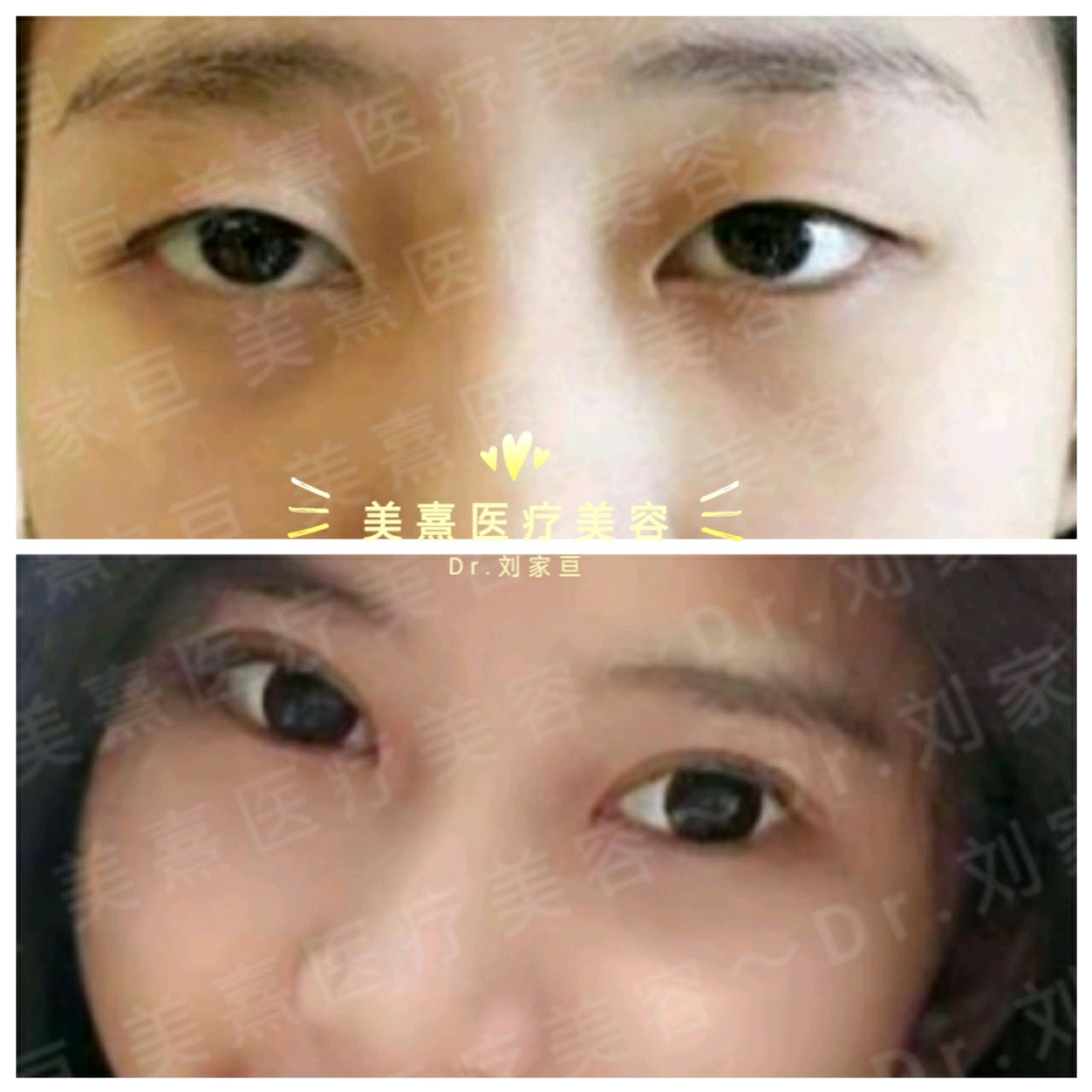 上眼皮太长 压在睫毛上了 现在看起来 新氧美容整形