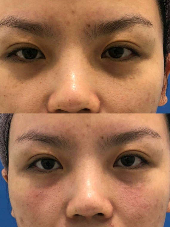 欧亚美玻尿酸填充泪沟案例分享