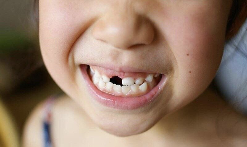 先天性缺牙,怎样做牙齿矫正