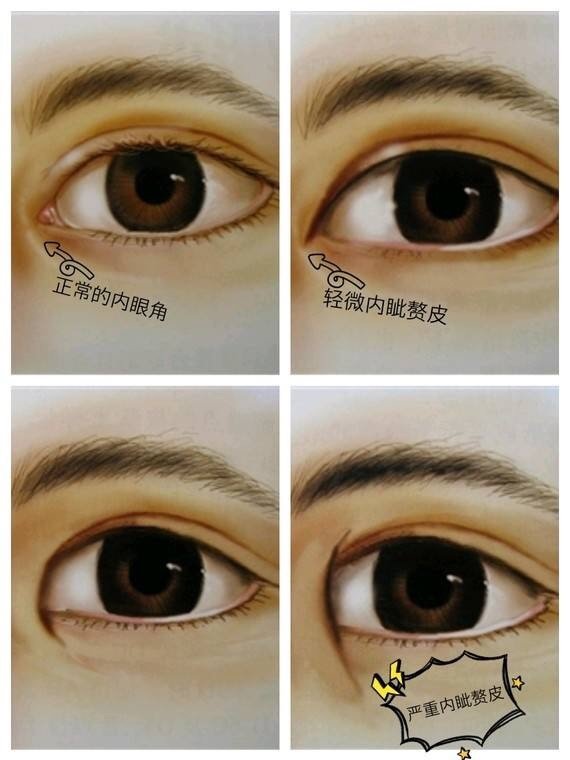 内眦赘皮 内眦赘皮就是上下眼睑之间的纵行皱皮,内眦赘皮会使眼帘变