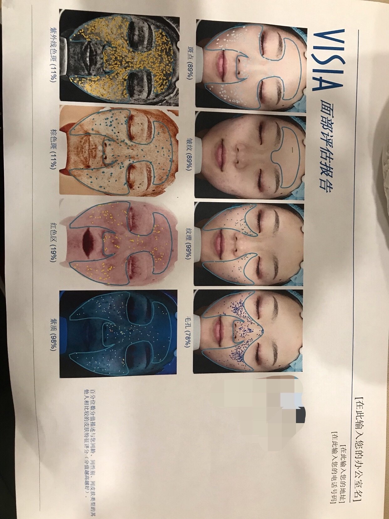 visia皮肤检测结果,痘印,晒斑等问题都比较严重,23岁的年龄,在同龄人