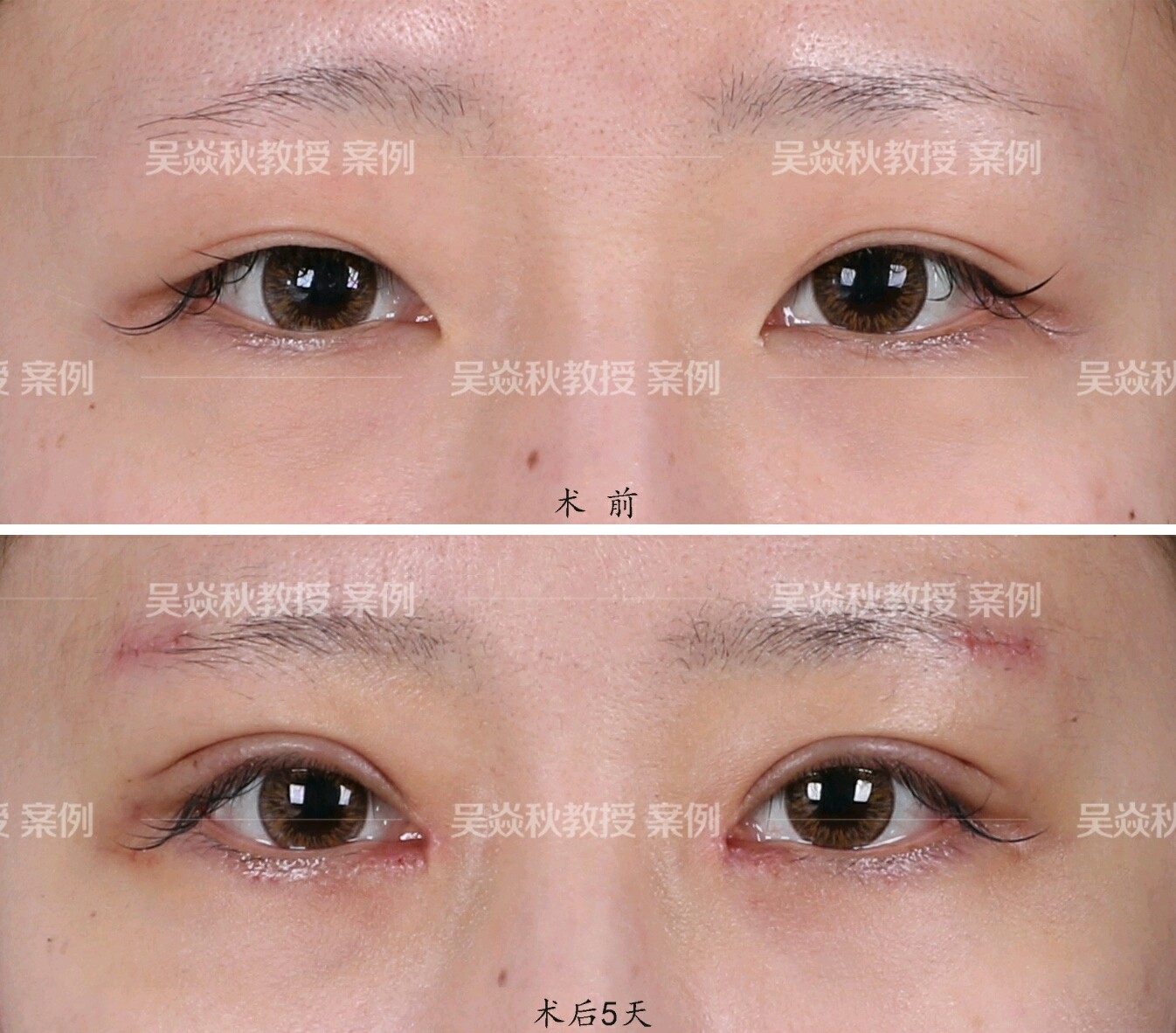 上眼皮太长 压在睫毛上了 现在看起来 新氧美容整形