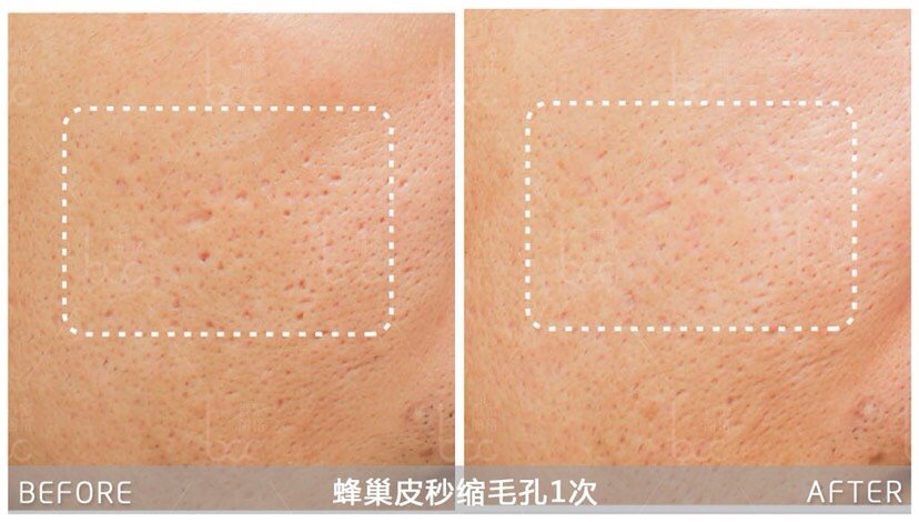 超皮秒可以缩小毛孔粗大的问题吗 新氧 专业医美服务平台