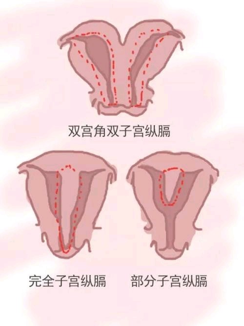 子宫隔膜图片